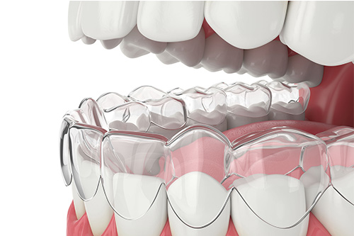 Invisalign in Bethesda