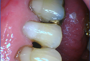 Bethesda Row Dental | Dental Sealants, Full Mouth Reconstruction and Digital Radiography