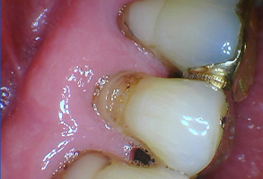 Bethesda Row Dental | Oral Cancer Screening, Sports Mouthguards and Invisalign reg 