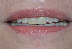 Bethesda Row Dental | Dentmat reg  Soft Tissue Laser, Implant Dentistry and Periodontal Treatments