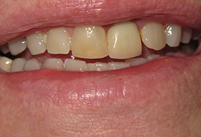 Bethesda Row Dental | Dental Bonding, Metal-Free Crowns  ceramic crowns  and Sleep Apnea