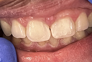 Bethesda Row Dental | Pediatric Dentistry, iTero reg  Element 5D Intraoral Scanner and Dental Cleanings