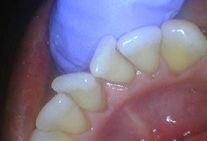 Bethesda Row Dental | SprintRay Pro Desktop 3D Printer, Invisalign reg  and Arestin  