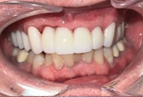 Bethesda Row Dental | TMJ TMD, Arestin   and Sports Mouthguards