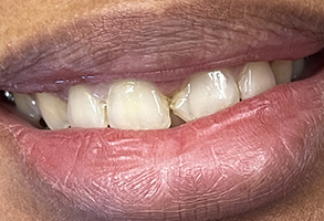 Bethesda Row Dental | Dentmat reg  Soft Tissue Laser, Arestin   and Veneers