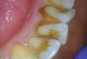 Bethesda Row Dental | View All, Invisalign reg  and Full Mouth Reconstruction