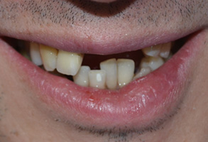 Bethesda Row Dental | iTero reg  Element 5D Intraoral Scanner, TMJ Pain and Veneers