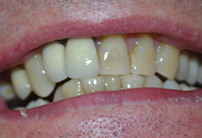 Bethesda Row Dental | Dental Emergencies, 3Shape TRIOS Scanner and Dental Cleanings