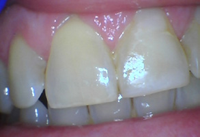 Bethesda Row Dental | Dentures, Fluoride Treatment and Oral Cancer Screening