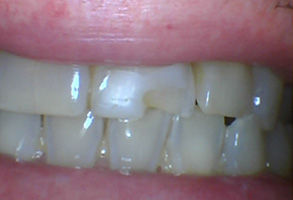 Bethesda Row Dental | Invisalign®, VELscope® Cancer Screening and Dental Sealants