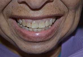 Bethesda Row Dental | View All, Fluoride Treatment and Oral Exams