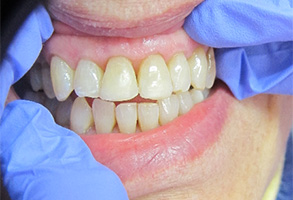 Bethesda Row Dental | View All, Periodontal Treatment and Sleep Apnea