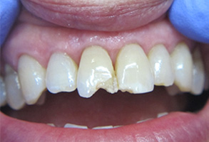 Bethesda Row Dental | Dentures, Oral Cancer Screening and Periodontal Treatment