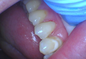 Bethesda Row Dental | Sports Mouthguards, Veneers and CBCT