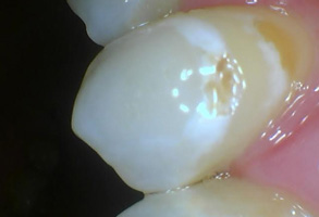 Bethesda Row Dental | Implant Dentistry, TMJ TMD and Dental Emergencies