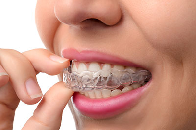 Invisalign in Bethesda